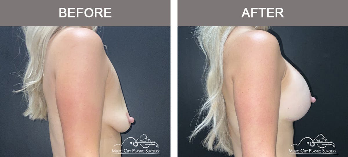 Breast Augmentation Before & After Gallery - Patient 290535 - Image 2