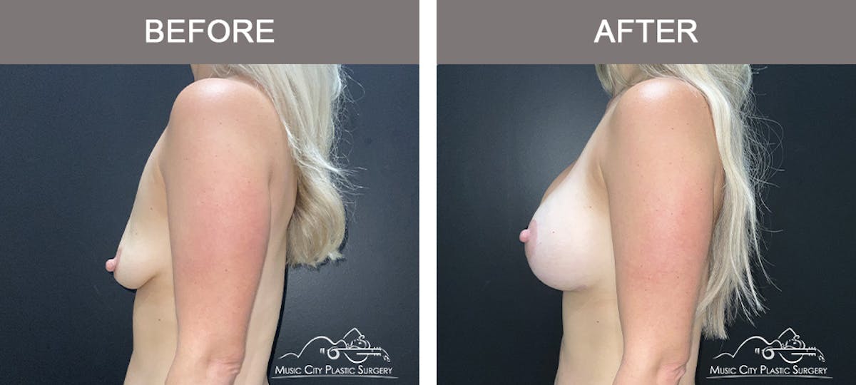Breast Augmentation Before & After Gallery - Patient 290535 - Image 3