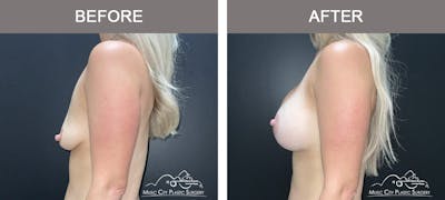 Breast Lift Before & After Gallery - Patient 184326 - Image 3