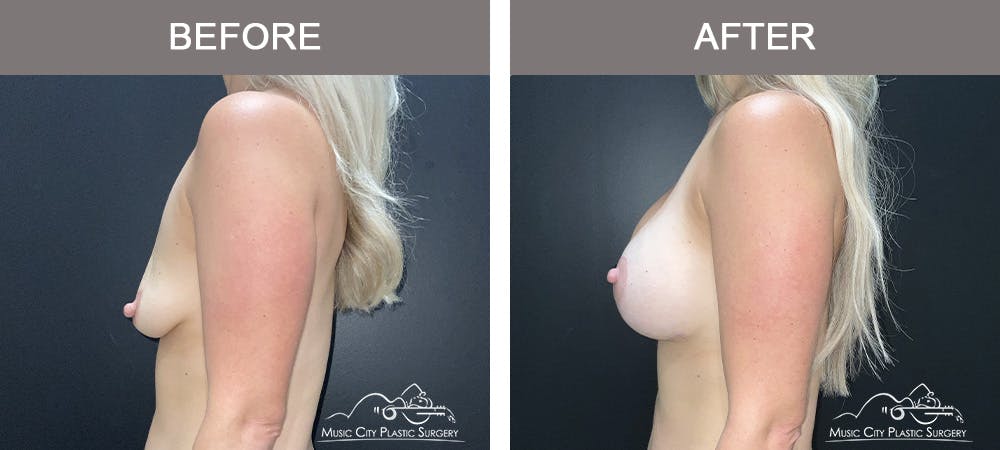 Breast Augmentation Before & After Gallery - Patient 290535 - Image 3