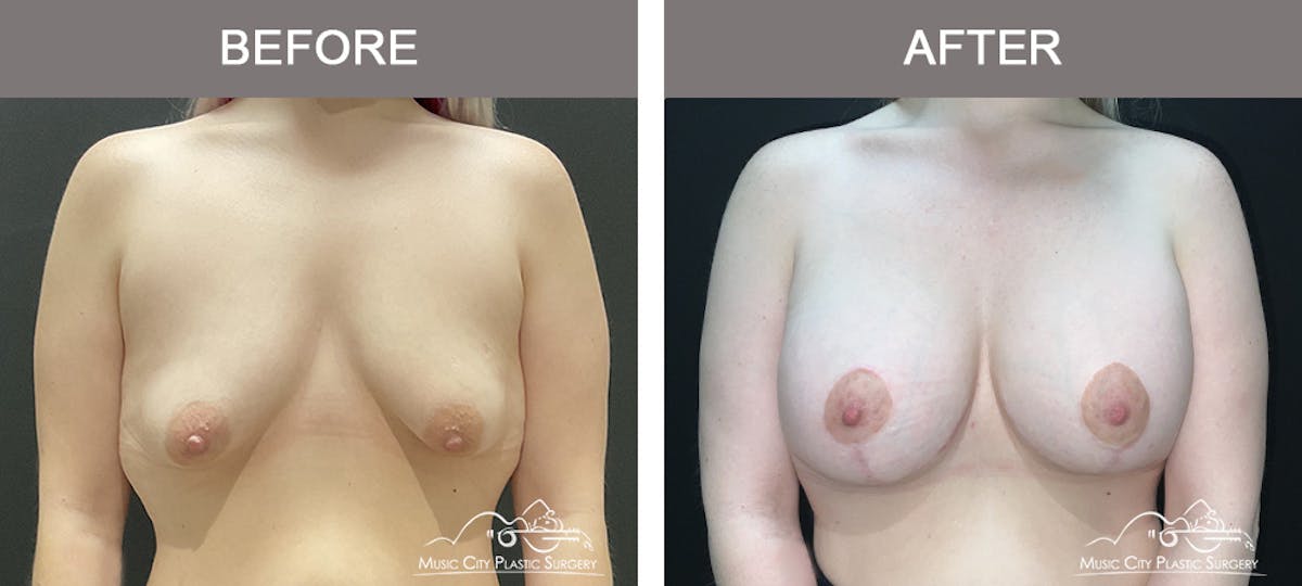 Breast Augmentation Before & After Gallery - Patient 349290 - Image 1