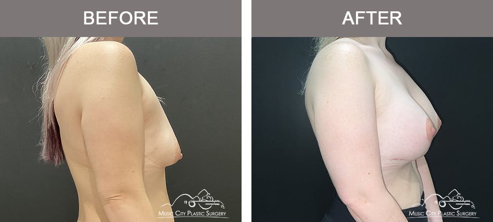 Breast Augmentation Before & After Gallery - Patient 349290 - Image 2