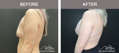 Breast Lift Before & After Gallery - Patient 251711 - Image 3