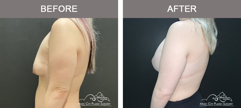 Breast Augmentation Before & After Gallery - Patient 349290 - Image 3
