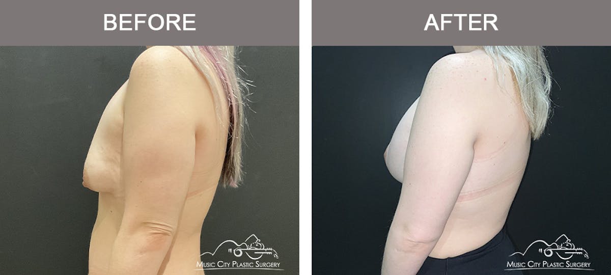 Breast Augmentation Before & After Gallery - Patient 349290 - Image 3