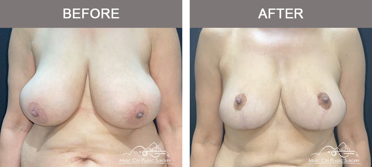 Breast Lift Before & After Gallery - Patient 129616 - Image 1