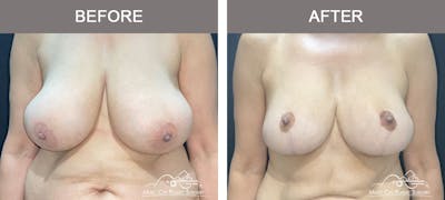 Breast Lift Before & After Gallery - Patient 129616 - Image 1