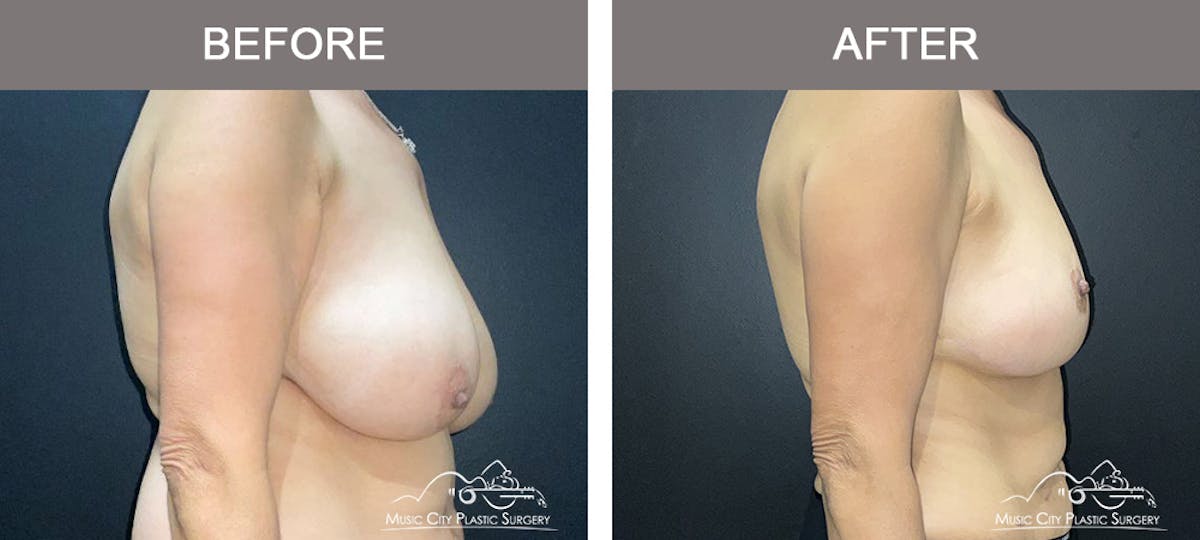Breast Lift Before & After Gallery - Patient 129616 - Image 2