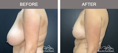 Breast Lift Before & After Gallery - Patient 129616 - Image 3