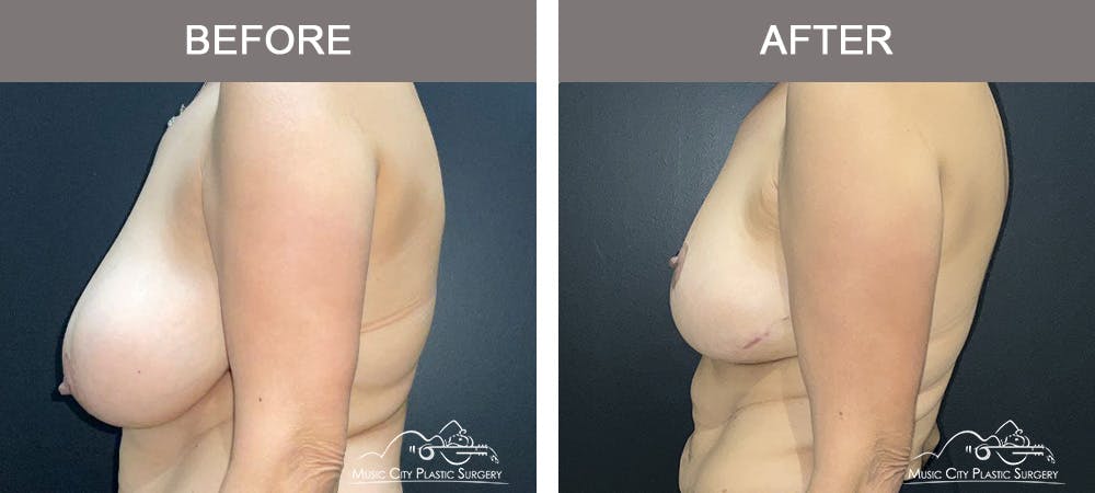 Breast Lift Before & After Gallery - Patient 129616 - Image 3