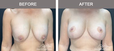 Breast Lift Before & After Gallery - Patient 359992 - Image 1