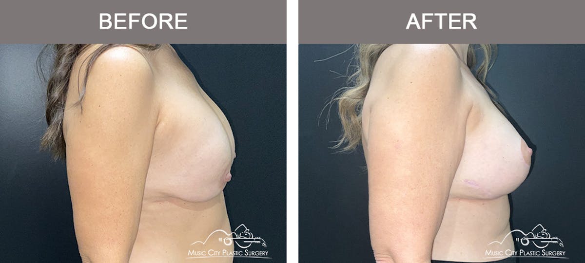 Breast Lift Before & After Gallery - Patient 359992 - Image 2