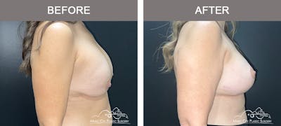 Implant Exchange Before & After Gallery - Patient 192554 - Image 2