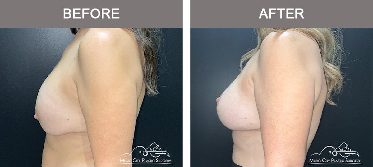 Breast Lift Before & After Gallery - Patient 359992 - Image 3