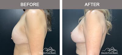 Implant Exchange Before & After Gallery - Patient 192554 - Image 3