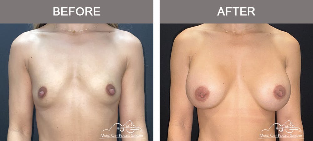 Breast Augmentation Before & After Gallery - Patient 182150 - Image 1