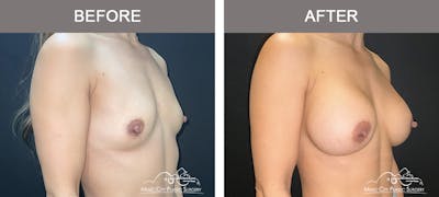 Breast Augmentation Before & After Gallery - Patient 182150 - Image 2