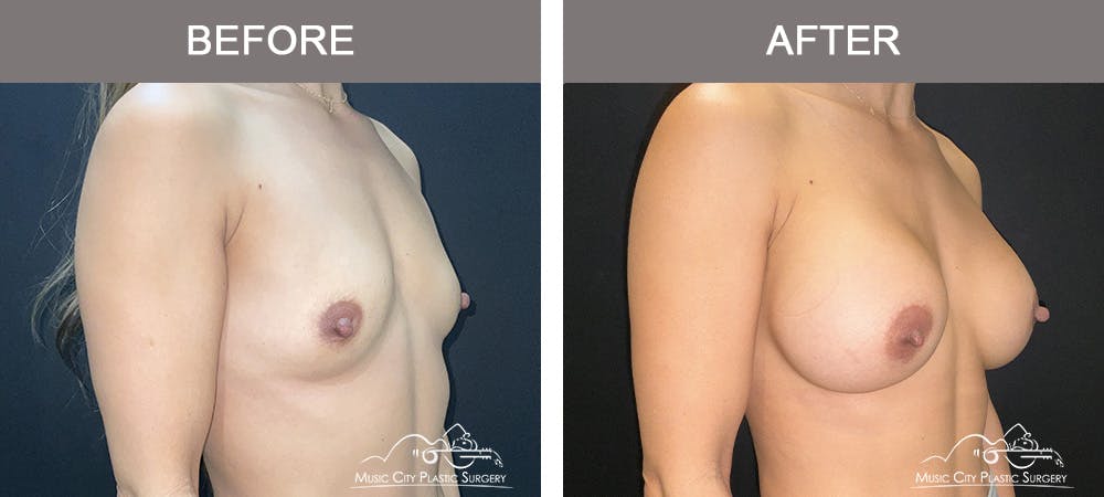 Breast Augmentation Before & After Gallery - Patient 182150 - Image 2