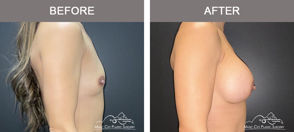 Breast Augmentation Before & After Gallery - Patient 182150 - Image 3