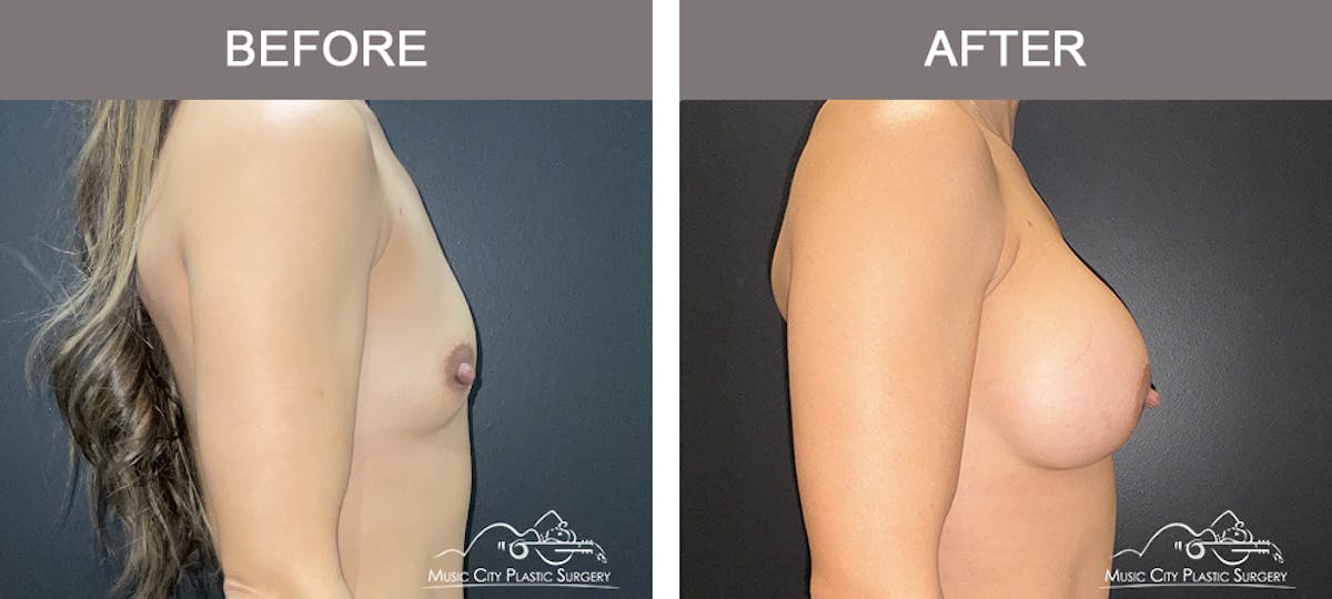 Breast Augmentation Before & After Gallery - Patient 182150 - Image 3