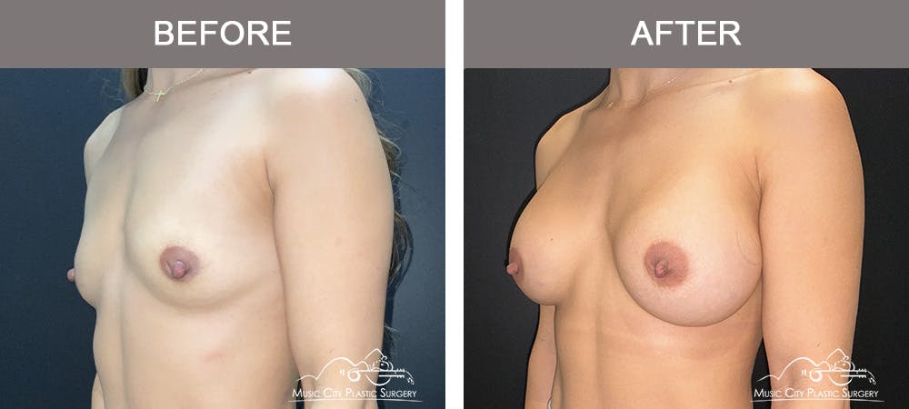 Breast Augmentation Before & After Gallery - Patient 182150 - Image 4