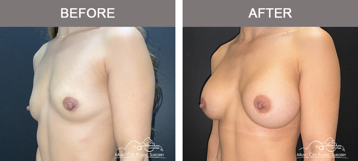 Breast Augmentation Before & After Gallery - Patient 182150 - Image 4