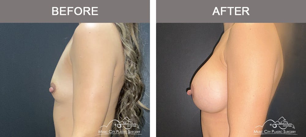 Breast Augmentation Before & After Gallery - Patient 182150 - Image 5