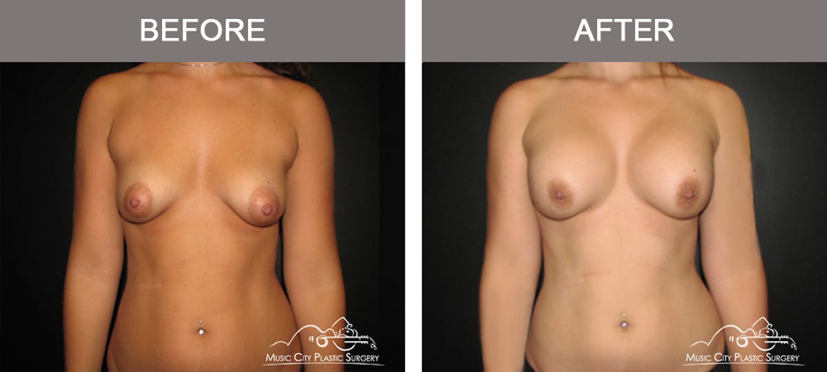 Breast Augmentation Before & After Gallery - Patient 330043 - Image 1