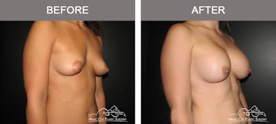 Breast Augmentation Before & After Gallery - Patient 330043 - Image 2