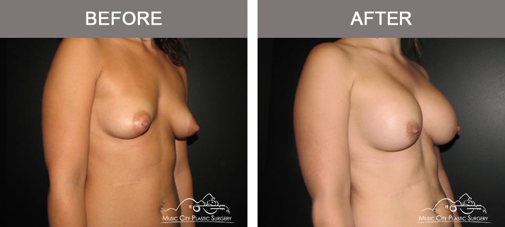Breast Augmentation Before & After Gallery - Patient 330043 - Image 2