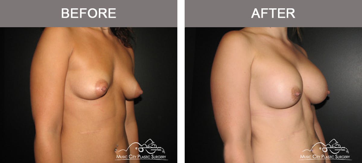 Breast Augmentation Before & After Gallery - Patient 330043 - Image 2