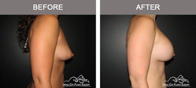 Breast Augmentation Before & After Gallery - Patient 330043 - Image 3