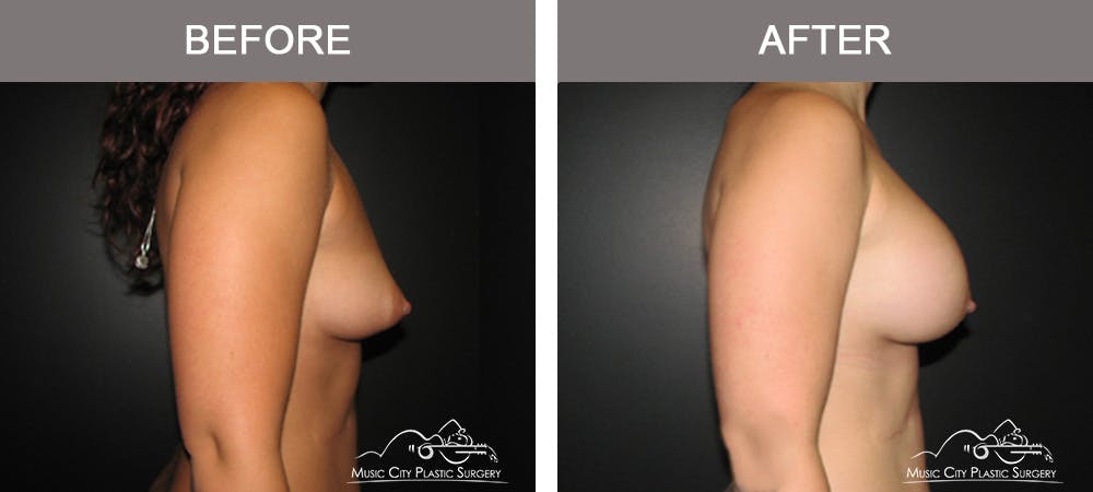Breast Augmentation Before & After Gallery - Patient 330043 - Image 3
