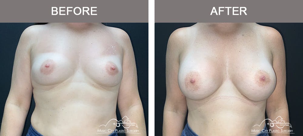 Breast Augmentation Before & After Gallery - Patient 218657 - Image 1