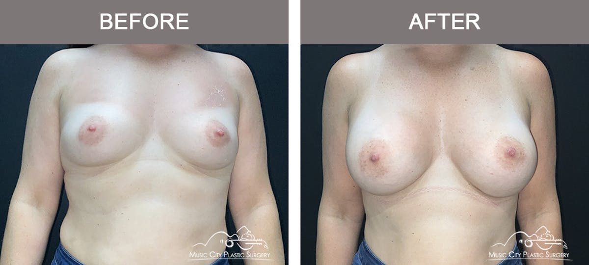 Breast Augmentation Before & After Gallery - Patient 218657 - Image 1