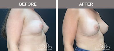 Breast Augmentation Before & After Gallery - Patient 218657 - Image 2