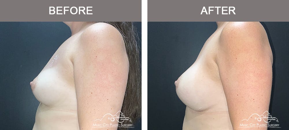 Breast Augmentation Before & After Gallery - Patient 218657 - Image 4