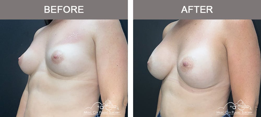 Breast Augmentation Before & After Gallery - Patient 218657 - Image 3