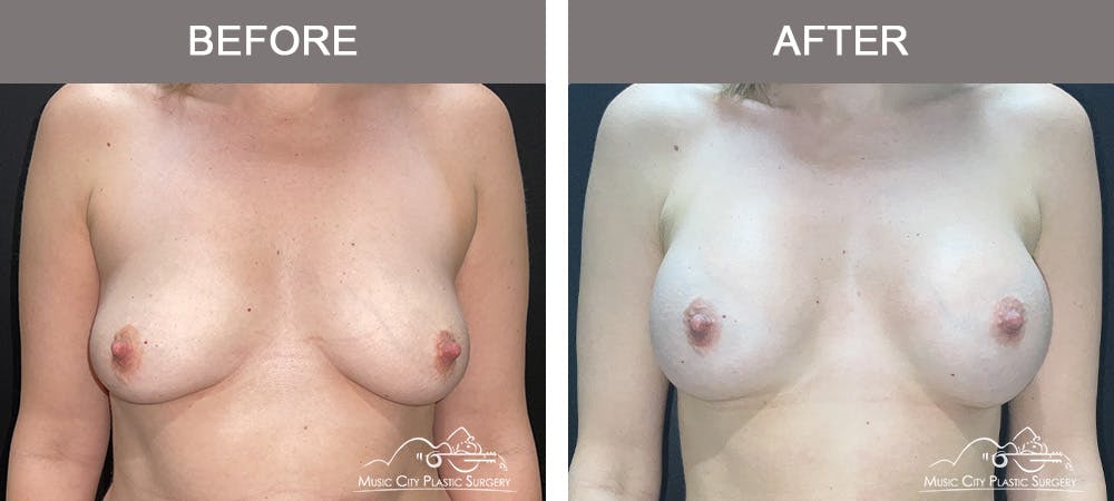 Breast Augmentation Before & After Gallery - Patient 412791 - Image 1