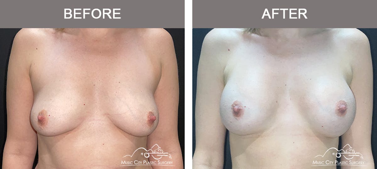 Breast Augmentation Before & After Gallery - Patient 412791 - Image 1