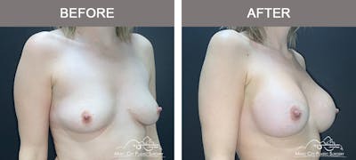 Breast Augmentation Before & After Gallery - Patient 412791 - Image 2