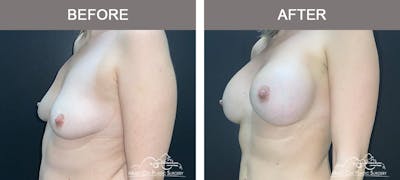Breast Augmentation Before & After Gallery - Patient 412791 - Image 3