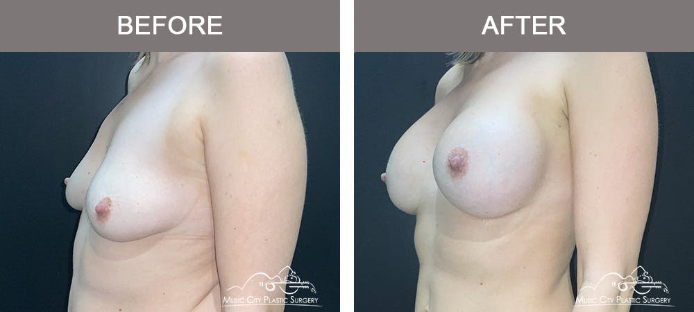 Breast Augmentation Before & After Gallery - Patient 412791 - Image 3