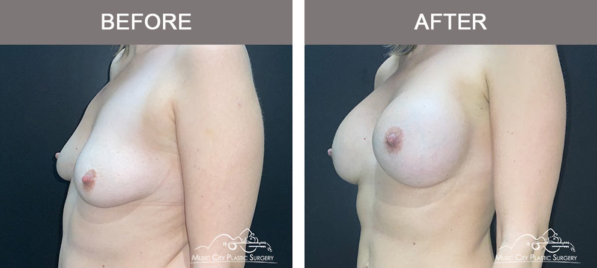 Breast Augmentation Before & After Gallery - Patient 412791 - Image 3