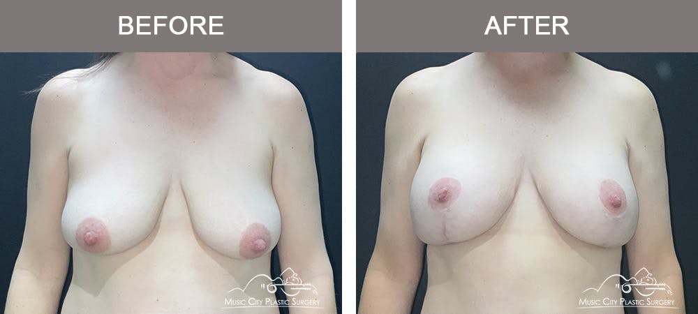Breast Augmentation Before & After Gallery - Patient 257911 - Image 1