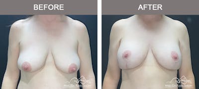 Breast Lift Before & After Gallery - Patient 326918 - Image 1