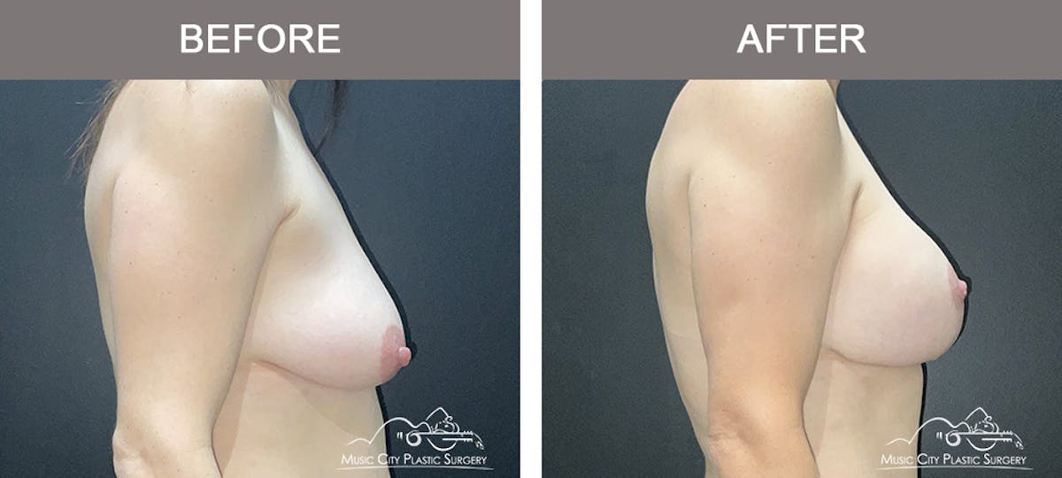 Breast Lift with Augmentation Before & After Gallery - Patient 355009 - Image 2