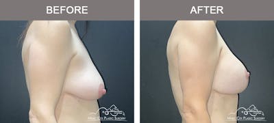 Breast Augmentation Before & After Gallery - Patient 257911 - Image 2