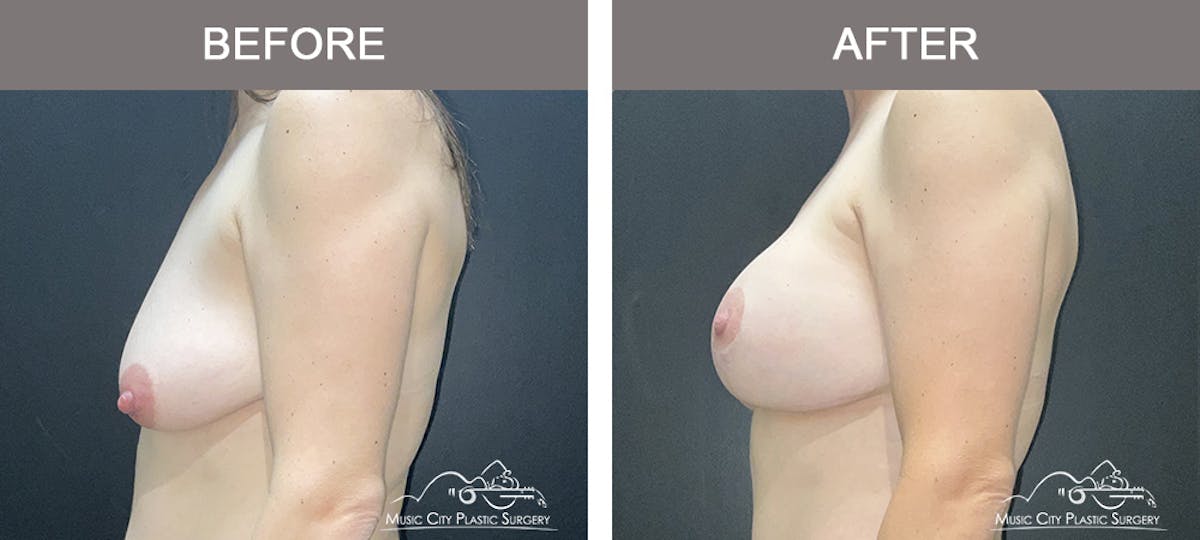 Breast Lift with Augmentation Before & After Gallery - Patient 355009 - Image 3