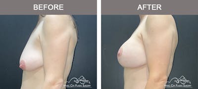 Breast Augmentation Before & After Gallery - Patient 257911 - Image 3